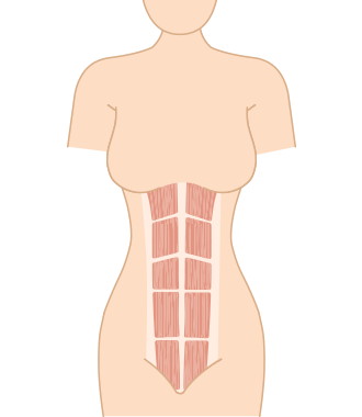 束腹帶 推薦 產後瘦身 剖腹產 竹炭加強型束腹腰夾